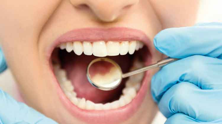 Çürük dişi onaran jel